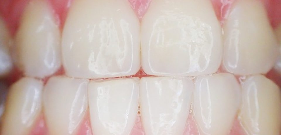 How A Veneer Can Help You